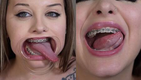 Braces Mouth Tour 3