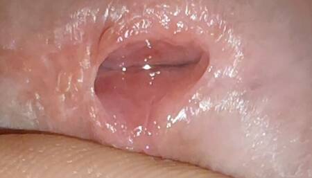 Opening Access to the Dick to Introduce the Anesthetic Serum
