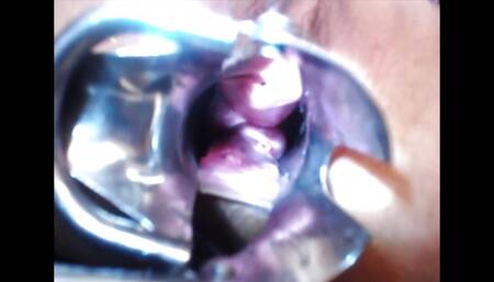 Speculum Cervix & Anal Exam Great View Inside