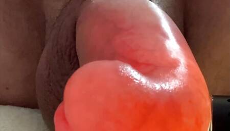 Glucose Saline Infusion