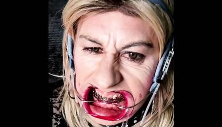 Extreme braces headgear and open mouth expander fetish