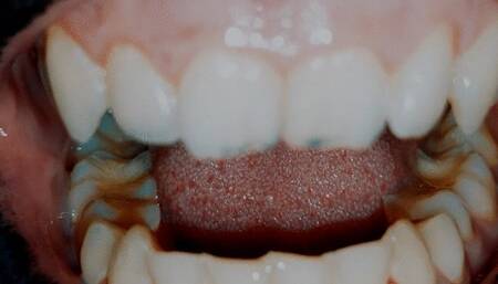 Dirty teeth