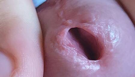 Incredible Hole covered by phimosis hinders the young boy.