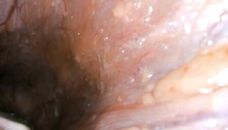 An Inside Look at Digestive Health: A Journey through the Gastrointestinal Tract Captured by PillCam Technology 720AVI