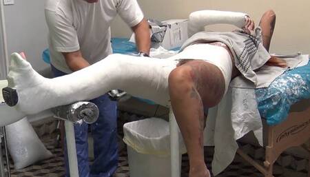 Naomi hip spica making finish