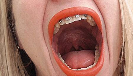 Blondie Yawning With Braces! MP4